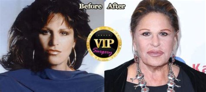 Fillers And Botox To Remain Youthful?